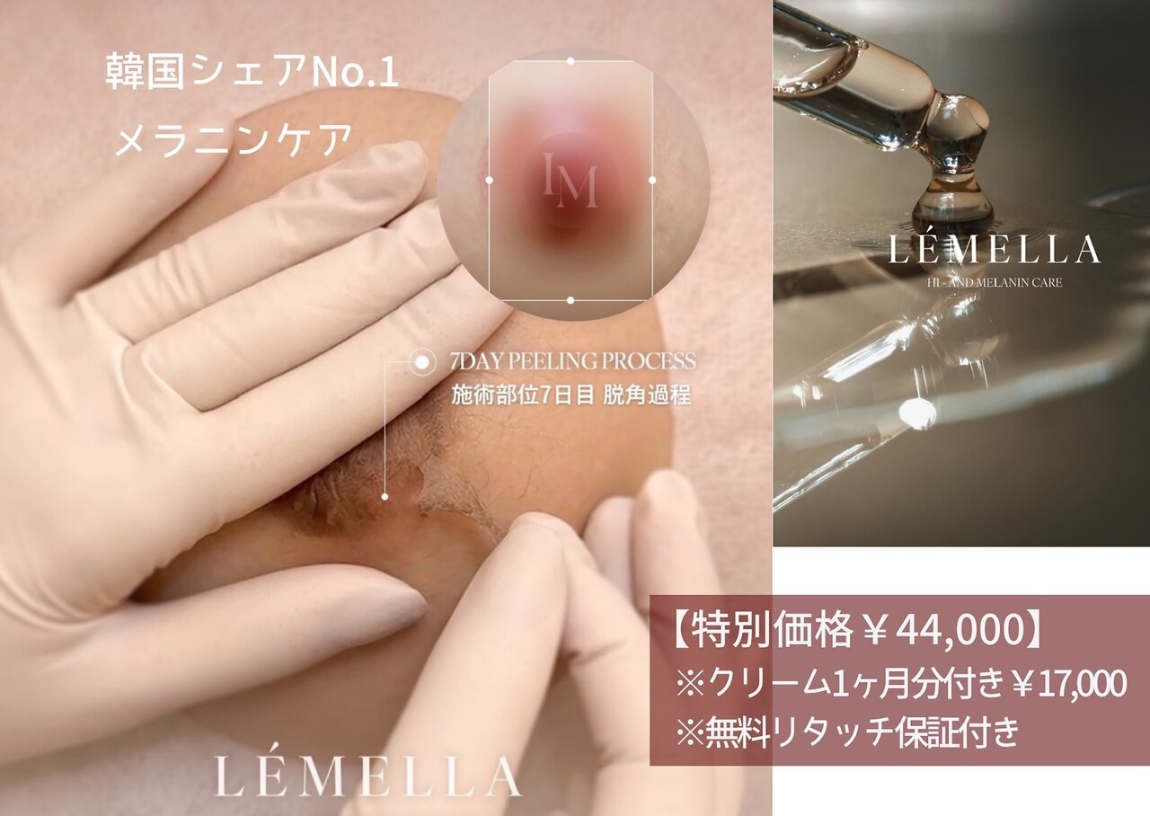 ヒゲ脱毛
