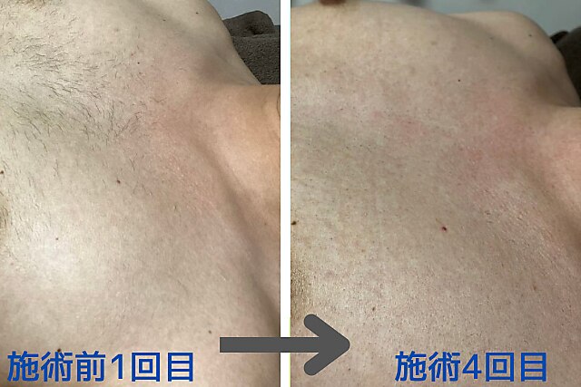 浮腫みスッキリ Before/After